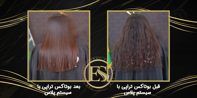 قبل و بعد بوتاکس تراپی با سیستم پلاس